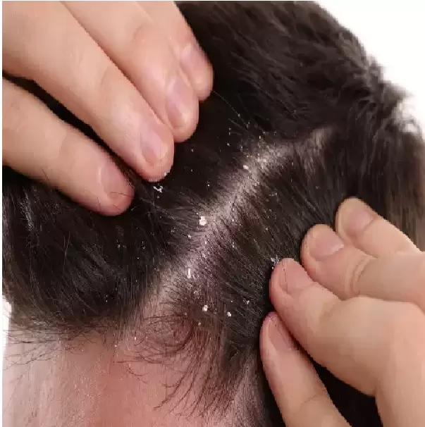 كلايمبازول وبيروكتون أولامين